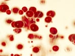 Sickle cell disease can cause severe anaemia, recurrent painful episodes, organ damage, stroke and other potentially life-threatening complications. (FILE)
