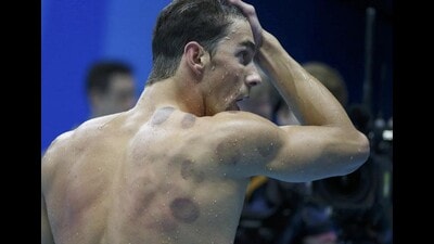 Michael Phelps is seen with red cupping marks on his shoulder as he competes in Rio Olympics. (Reuters) Michael Phelps is seen with red cupping marks on his shoulder as he competes in Rio Olympics. (Reuters)