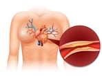 High LDL cholesterol often presents no symptoms, leading individuals to overlook potential cardiovascular risks. (Freepik)