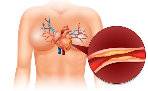 High LDL cholesterol often presents no symptoms, leading individuals to overlook potential cardiovascular risks.