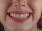 Why your teeth may develop rough edges over time and what you can do about it.(Unsplash)