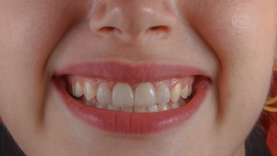Why your teeth may develop rough edges over time and what you can do about it. (Unsplash) Why your teeth may develop rough edges over time and what you can do about it. (Unsplash)