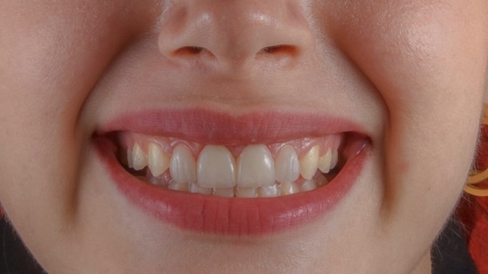Why your teeth may develop rough edges over time and what you can do about it.