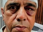 Victim Mohinder Kumar Sharda in Ludhiana on Monday. (HT Photo)