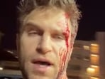 Keegan Allen shared a video of his bloodied face after the incident on Instagram.