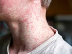Childhood rashes can result from infections, allergies, eczema, insect bites or irritation. 