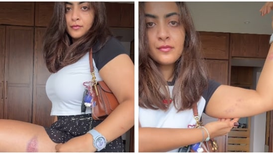 Zayn Marie showed marks on her body a day after the detention.