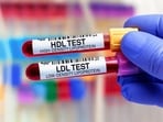 Being slim does not means you will have healthy cholesterol levels.
