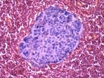Light micrograph showing metastatic breast cancer in a lymph node.