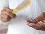 Hair loss can continue after a successful hair transplant, shares Dr Desai. 