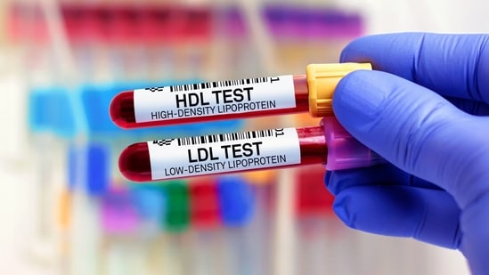 Being slim does not means you will have healthy cholesterol levels. (Adobe Stock)