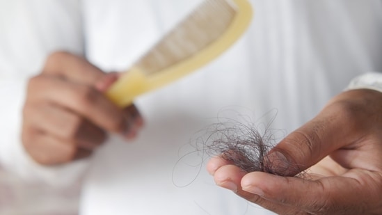 Hair loss can continue after a successful hair transplant, shares Dr Desai. 