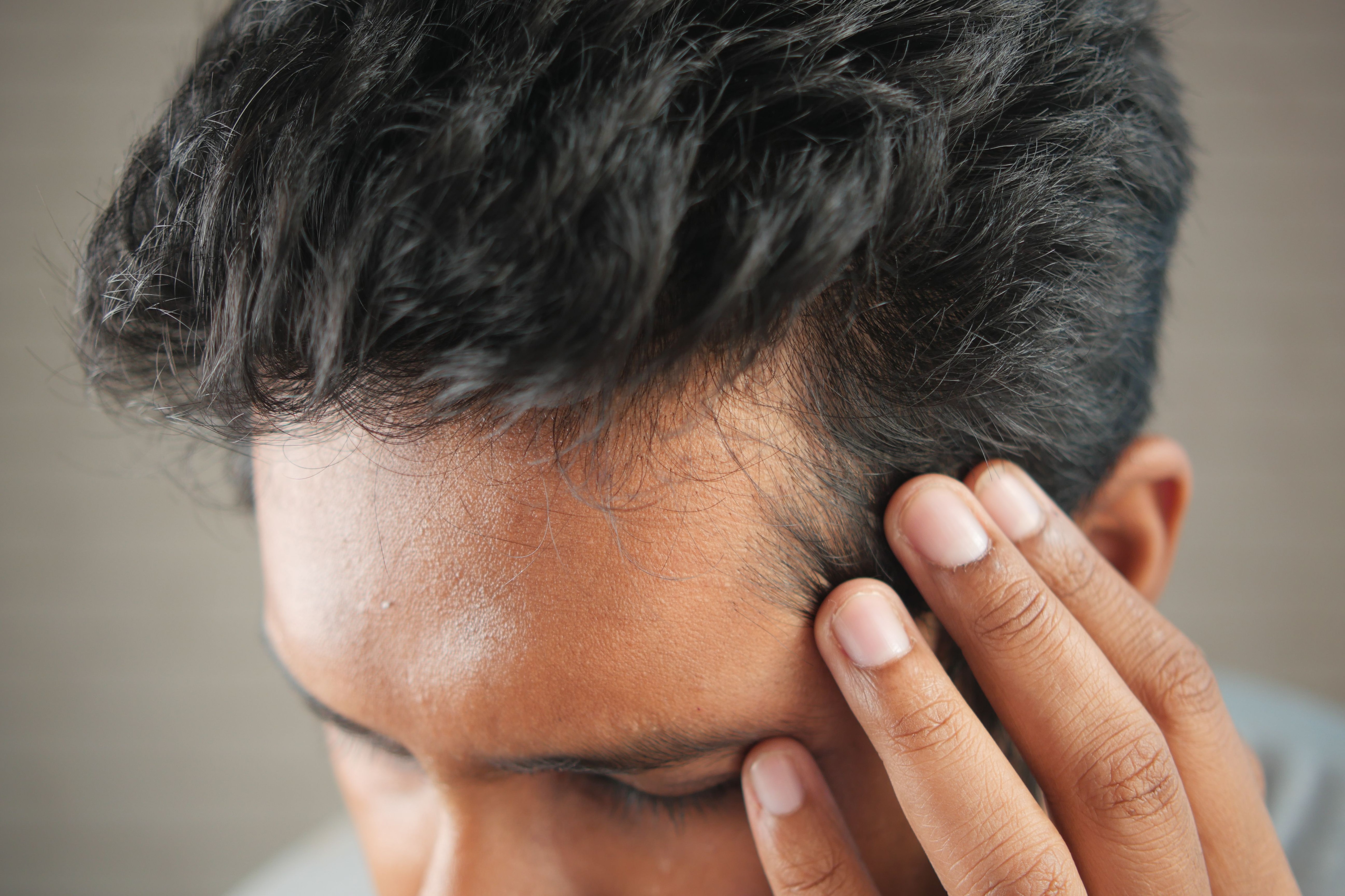 Hair loss is a condition that requires management and does not have a one-time fix, shares Dr Desai. (Pexel) Hair loss is a condition that requires management and does not have a one-time fix, shares Dr Desai. (Pexel)