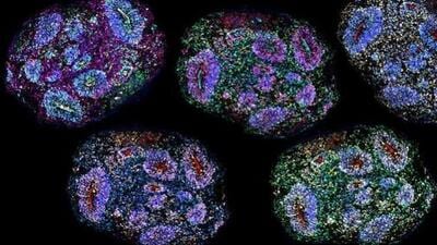 The Supreme Court has allowed existing autism patients to continue stem cell therapy temporarily The Supreme Court has allowed existing autism patients to continue stem cell therapy temporarily