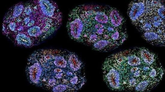 The Supreme Court has allowed existing autism patients to continue stem cell therapy temporarily