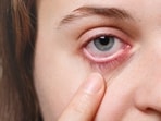 Eye injuries require to be handled with due precautions. 