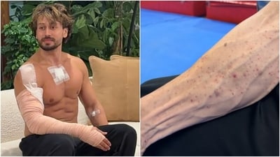 Tiger Shroff's team's video seemed to explain his bandages in first pictures after the firing.