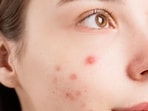 Here's what your acne reveals about your skin.(Pexel)