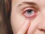 Smog affects your eyes too: Doctor shares care tips, common mistakes and signs you need medical help
