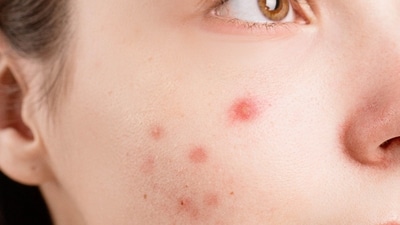 Here's what your acne reveals about your skin. (Pexel) Here's what your acne reveals about your skin. (Pexel)