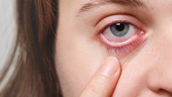 Smog affects your eyes too: Doctor shares care tips, common mistakes and signs you need medical help