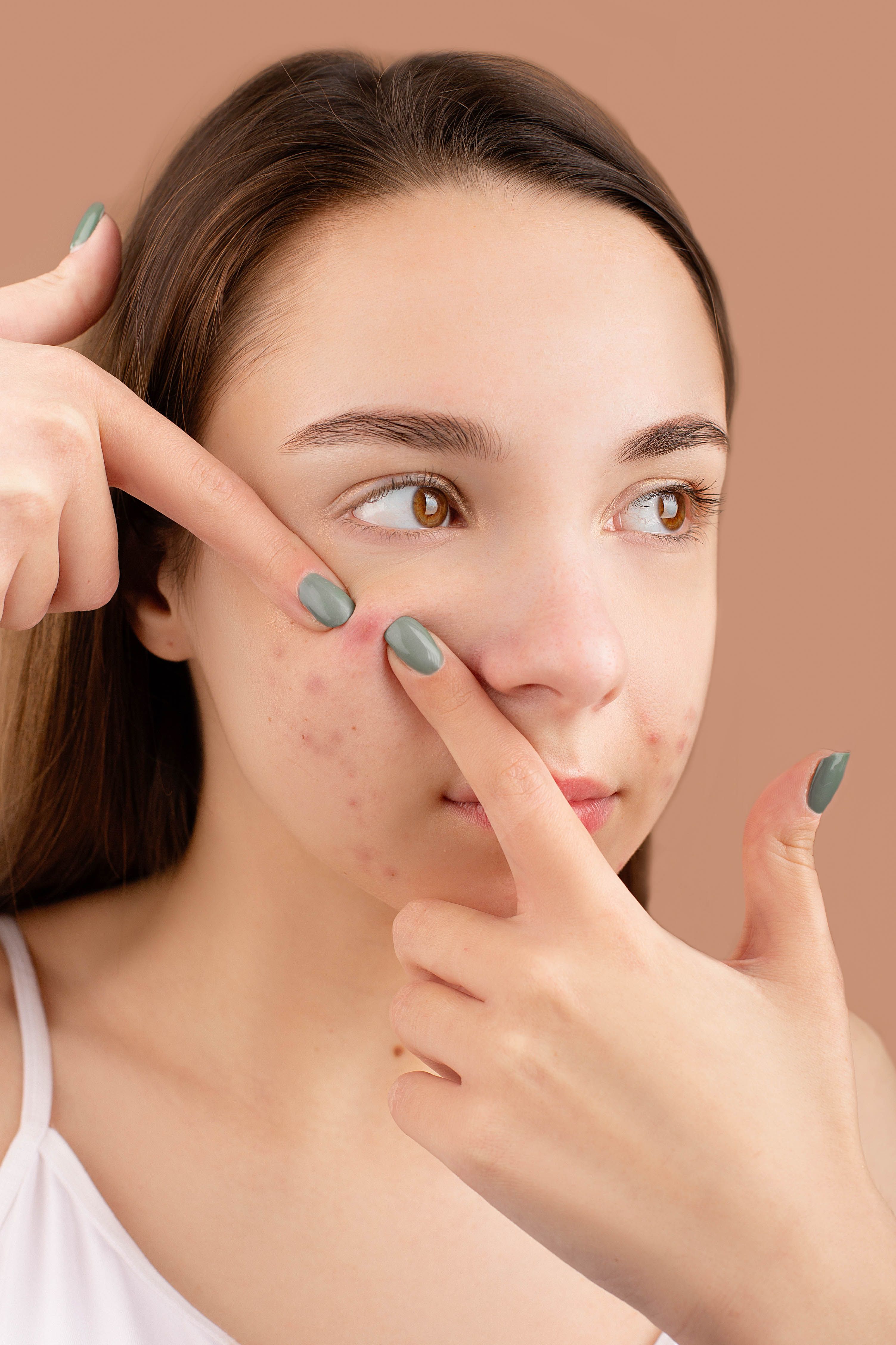 Acne predominantly affecting the forehead and hairline is often influenced by occlusion. (Pexel) Acne predominantly affecting the forehead and hairline is often influenced by occlusion. (Pexel)