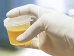 When you’re dehydrated, the urine will be darker in colour and more concentrated. (Shutterstock)