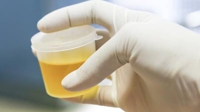 When you’re dehydrated, the urine will be darker in colour and more concentrated. (Shutterstock) When you’re dehydrated, the urine will be darker in colour and more concentrated. (Shutterstock)