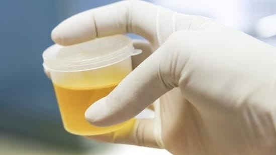 When you’re dehydrated, the urine will be darker in colour and more concentrated. 