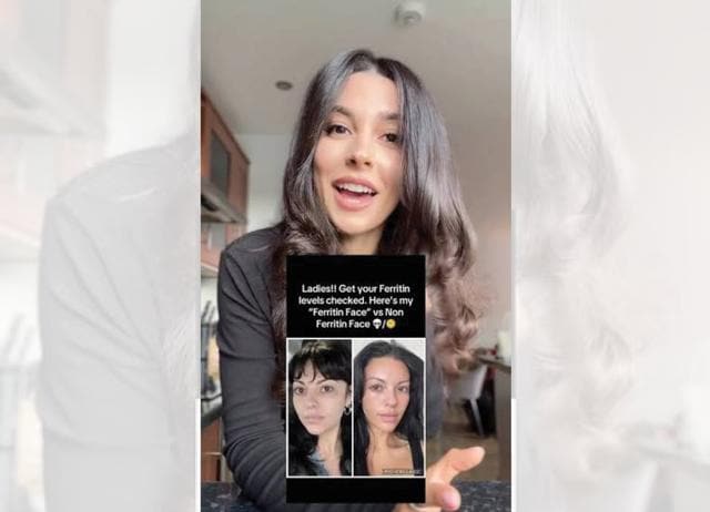 Ferritin Face is TikTok’s latest beauty flaw. Apparently, low iron levels make you less attractive. (TIKTOK@DERILISDIETITIAN) Ferritin Face is TikTok’s latest beauty flaw. Apparently, low iron levels make you less attractive. (TIKTOK@DERILISDIETITIAN)